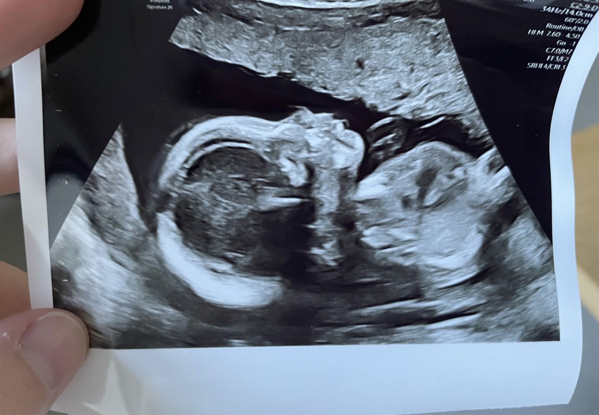 Echografie van de baby, in profiel